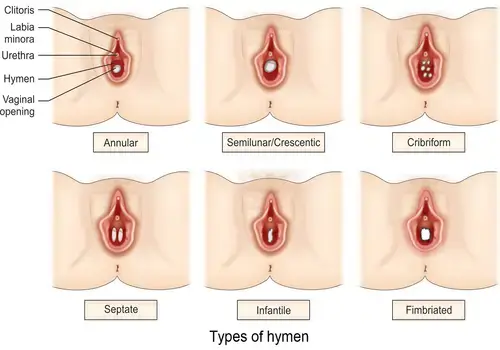 types-of-hymen