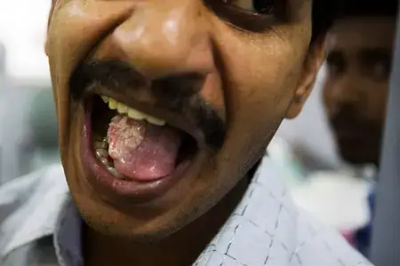 a-cancer-patient-showing-his-mouth-cancer