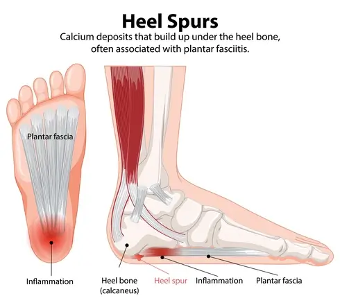 heel-spurs-and-plantar-fasciitis-infographic