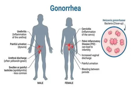 infographic-image-of-gonorrhea-symptoms